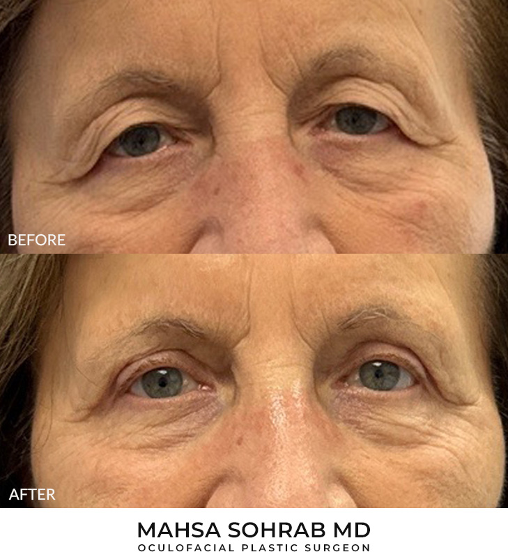 76 year old woman who was bothered by her upper eyelid appearance. She underwent upper eyelid blepharoplasty and internal browpexy. After photos show results at 3 months post-surgery.