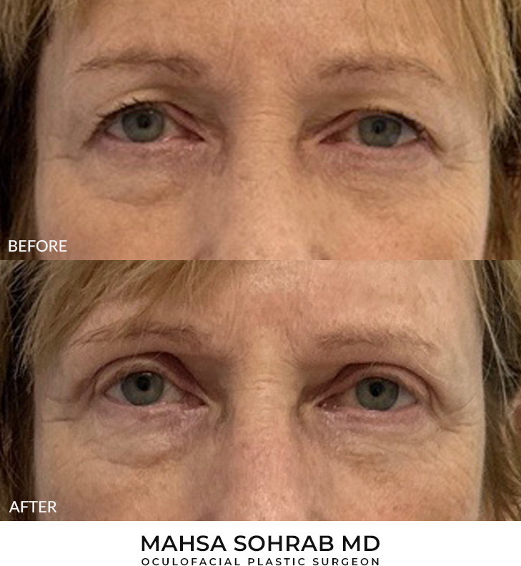 69 year old woman who was bothered by her upper eyelid appearance. She underwent upper eyelid blepharoplasty and internal browpexy. After photos show results at 1 month and 3 months after surgery.