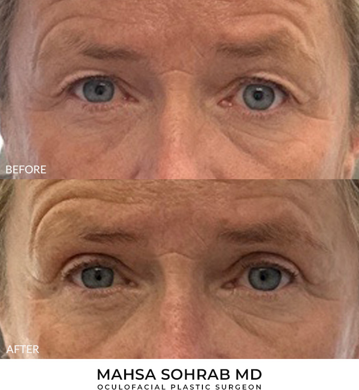 55 year old woman who was bothered by her upper eyelid appearance. She underwent upper eyelid blepharoplasty. After photos show results at 1 month and 3 months after surgery.