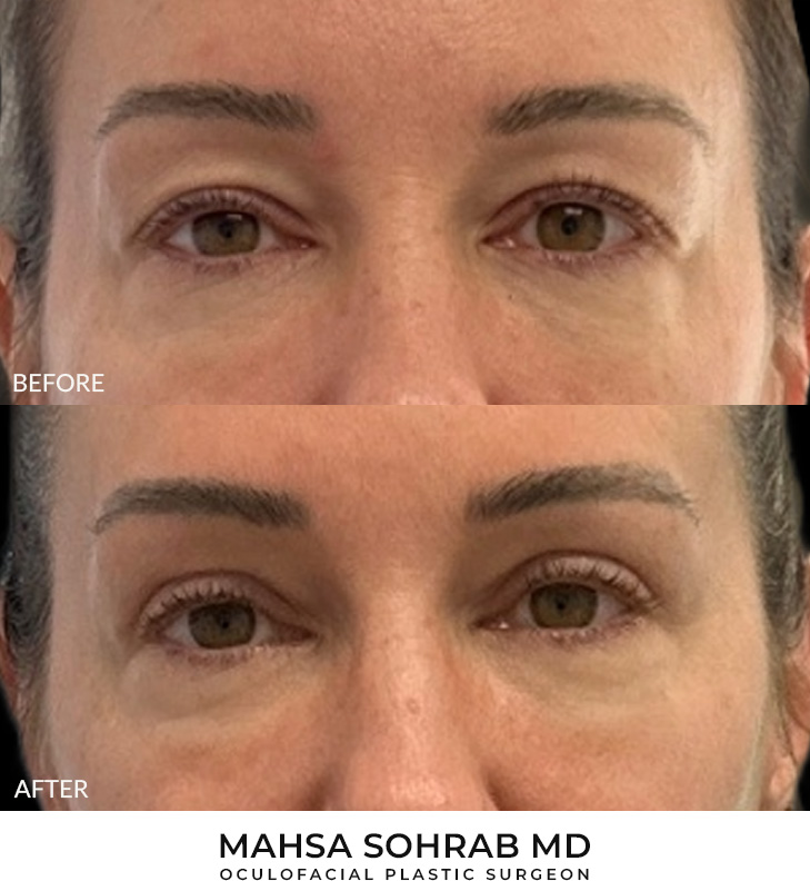 45 year old woman who was bothered by her upper eyelid appearance. She underwent upper eyelid blepharoplasty. After photos show results at 3 months after surgery.