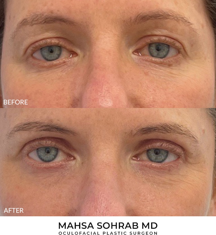 54 year old woman who was bothered by upper eyelid appearance. She underwent upper eyelid blepharoplasty with CO2 resurfacing in-office under local anesthesia. After photos display results 4 months post-surgery. Results can last 10 years.