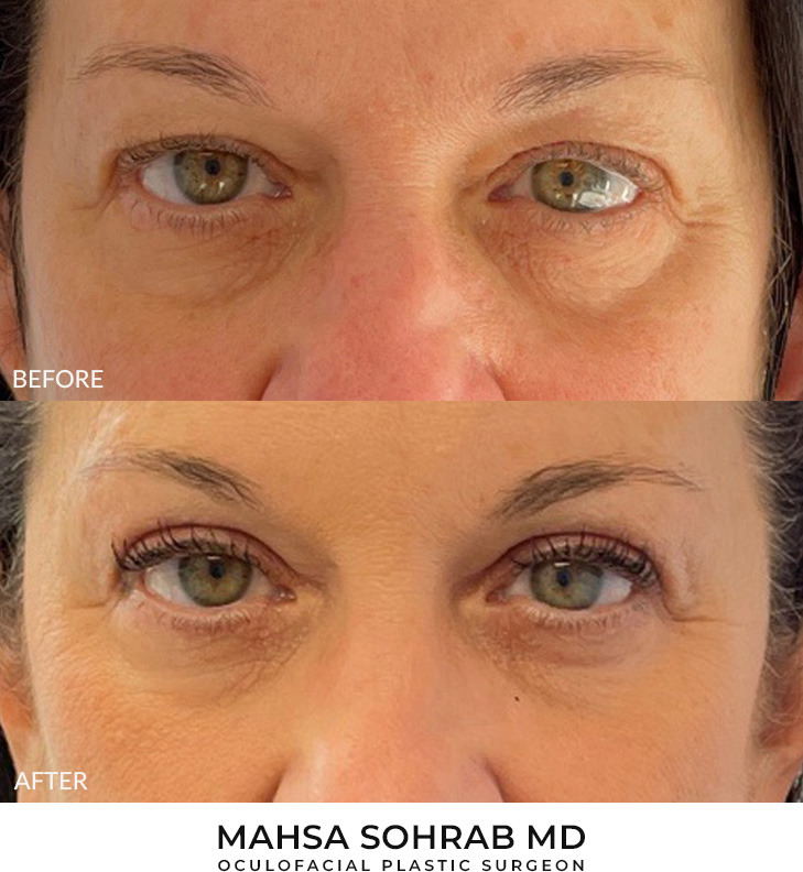 55 year old woman who was bothered by her upper eyelid appearance. She underwent in-office upper eyelid blepharoplasty and CO2 skin resurfacing. After photos show progression at 1 month and 3 months post-surgery. Results can last 10 years.