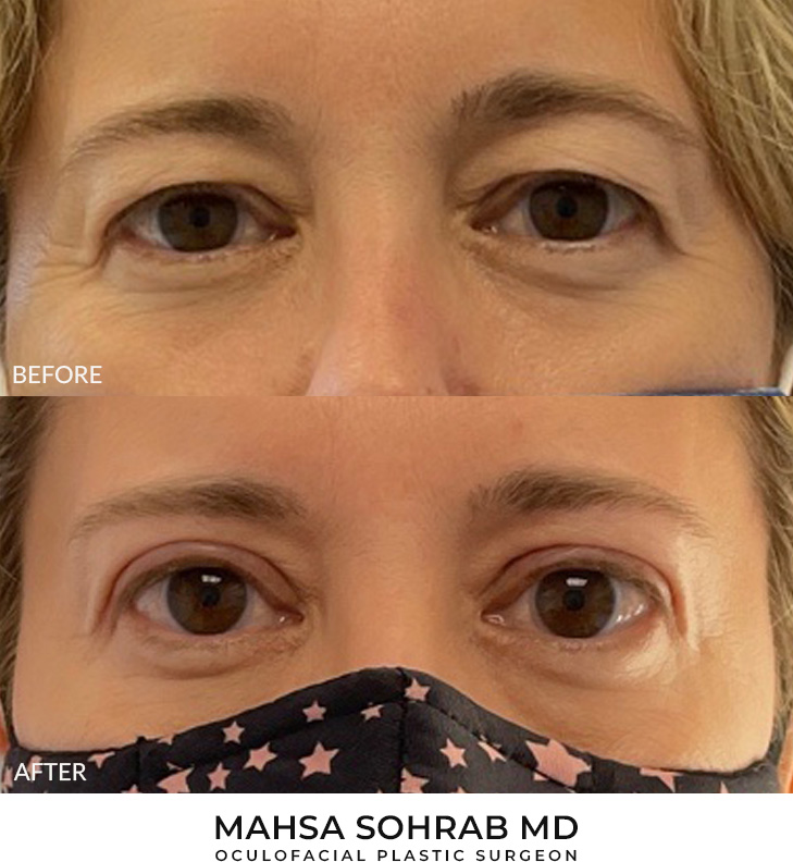 48 year old woman who was bothered by her upper eyelid appearance. She underwent in-office upper eyelid blepharoplasty. After photos show progression at 1 month and 3 months post-surgery. Results can last 10 years.