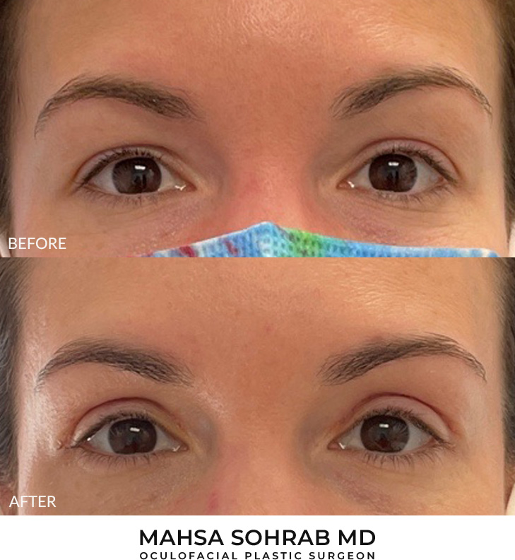 35 year old woman who was bothered by her upper eyelid appearance. She underwent in-office upper eyelid blepharoplasty. After photos show progression at 1 month post-surgery. Results can last 10 years.