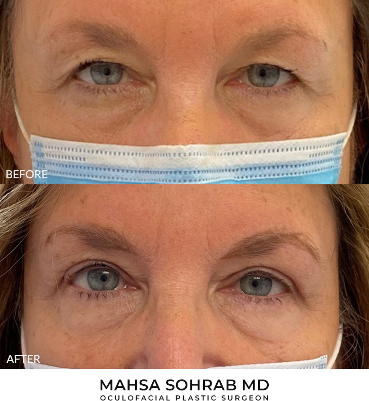 67 year old woman who was bothered by her upper eyelid appearance. She underwent in-office upper eyelid blepharoplasty. After photos show progression at 1 month post-surgery. Results can last 10 years.