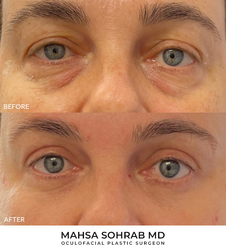 50 year old woman who was bothered by her upper and lower eyelid appearance. She underwent upper and lower eyelid blepharoplasty and CO2 resurfacing. After photos are from 3 months post-surgery. Results can last 10 years.