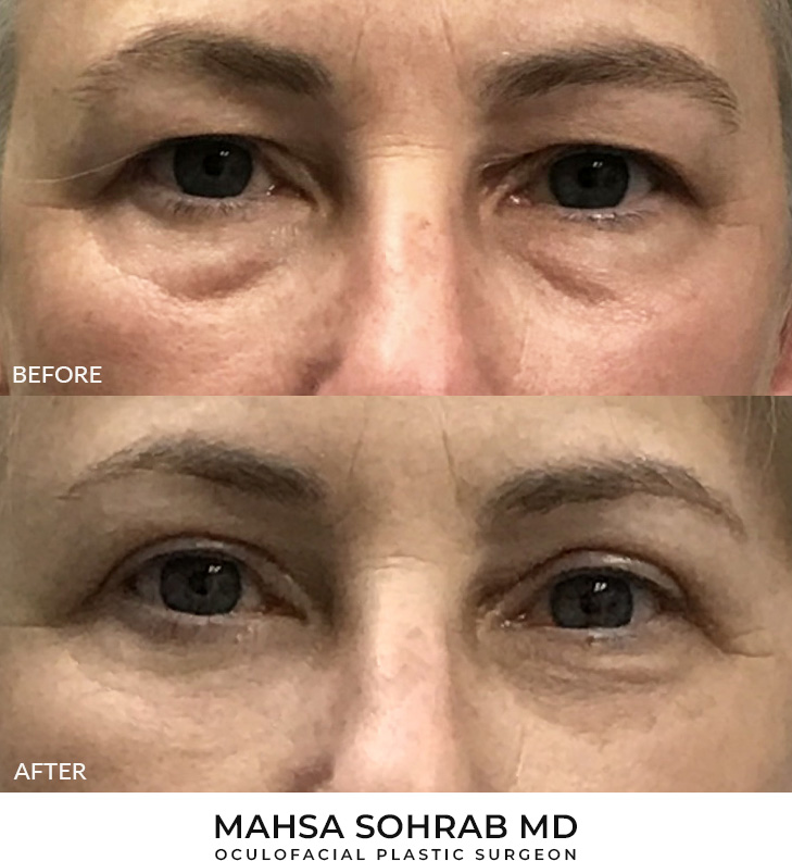 56 year old woman who was bothered by her upper and lower eyelid appearance. She underwent upper and lower eyelid blepharoplasty. After photos are 3 months post-surgery. Results can last 10 years.