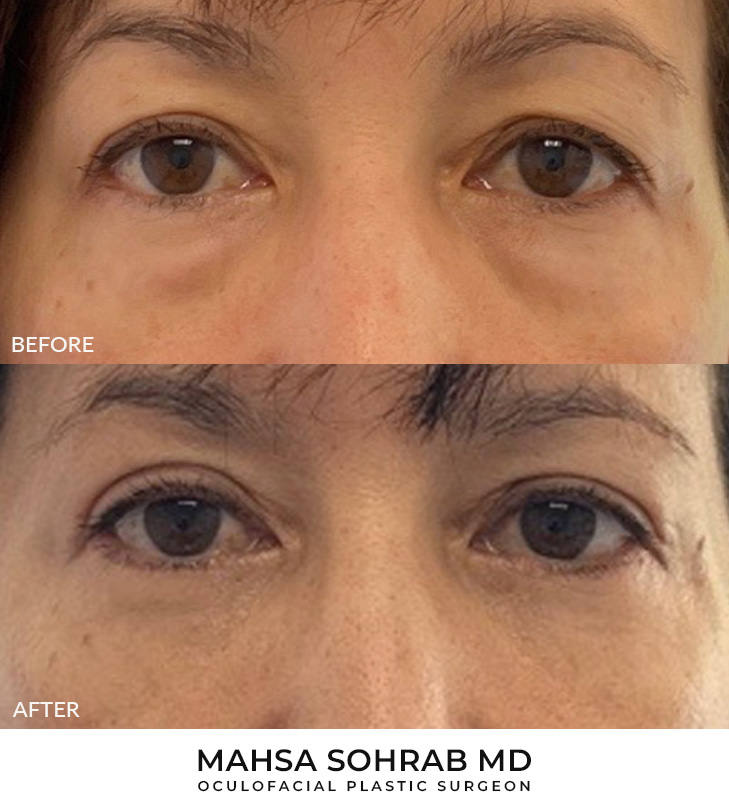56 year old woman who was bothered by her upper and lower eyelid appearance. She underwent upper and lower eyelid blepharoplasty with fat transposition. After photos are shown at 3 months post-surgery.