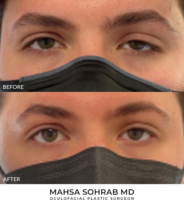 Ptosis Repair Patient 13