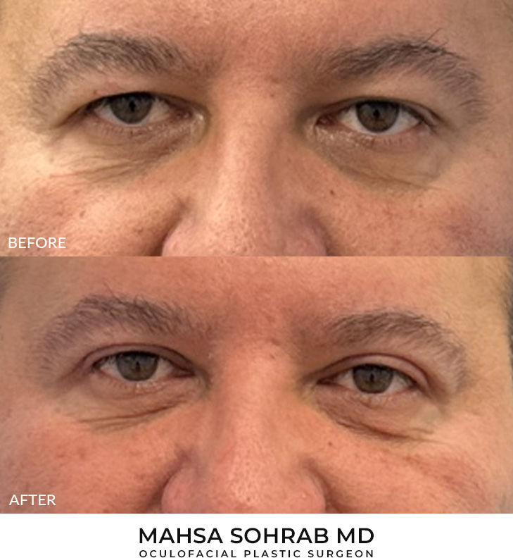 Male Blepharoplasty Patient 07