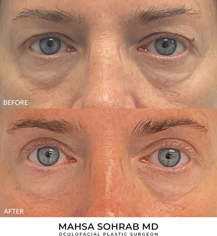 Upper Blepharoplasty