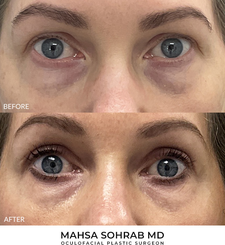Upper Blepharoplasty Patient 32