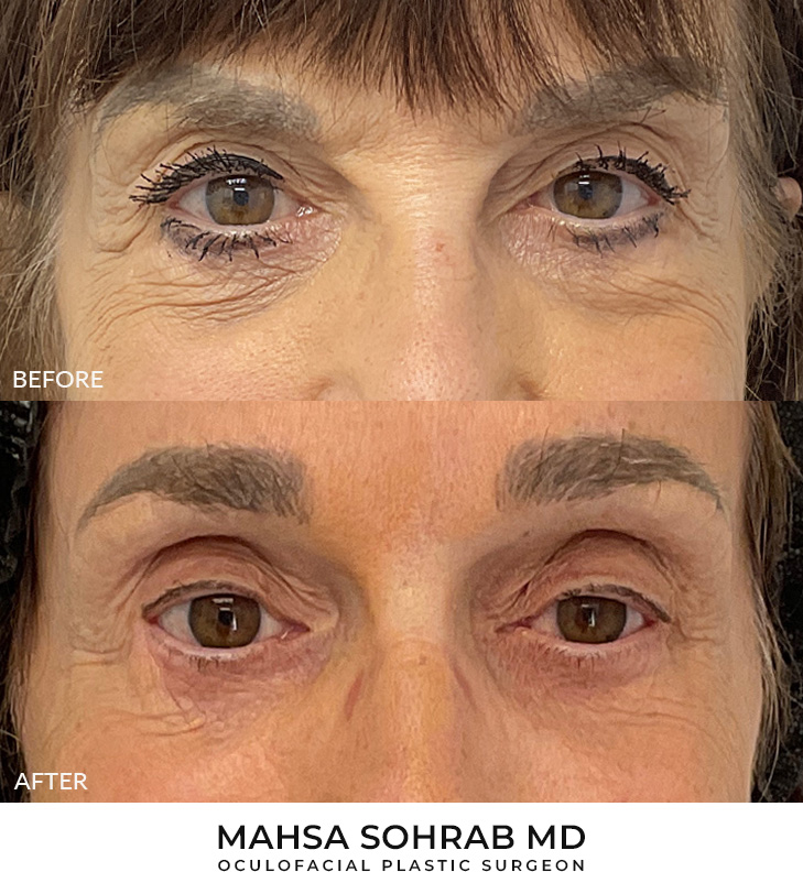 Brow Lift patient 02