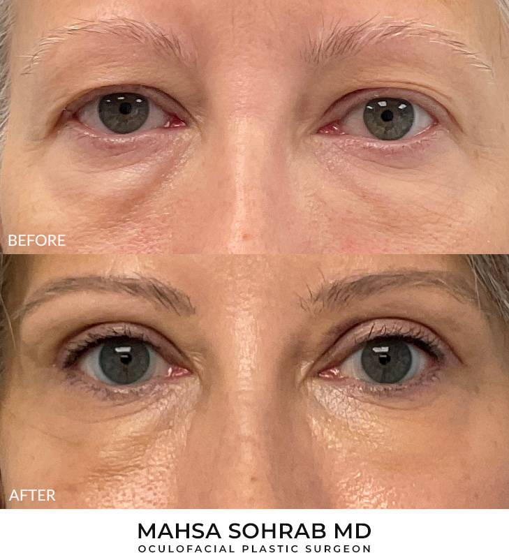 Upper Blepharoplasty
