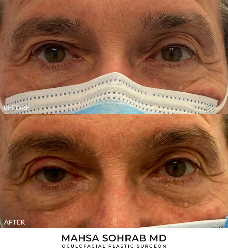 Ptosis Repair Patient 11