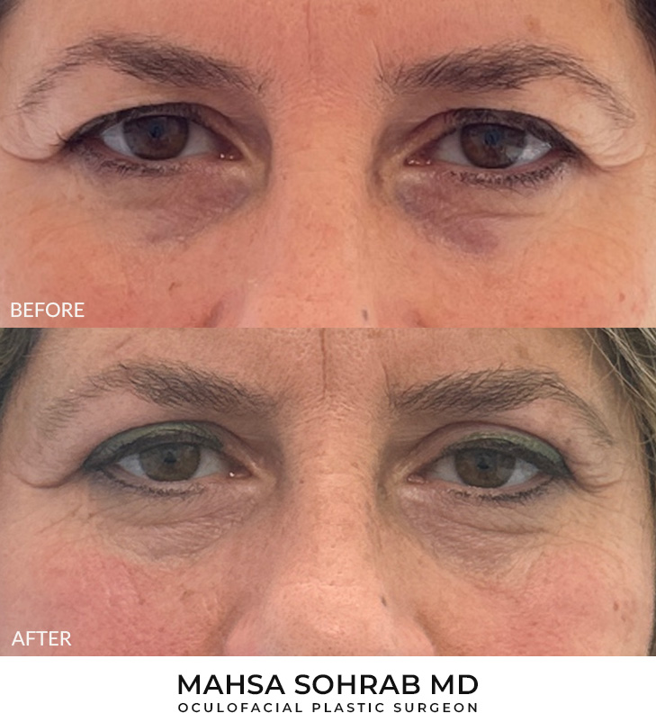 Upper Blepharoplasty Patient 31