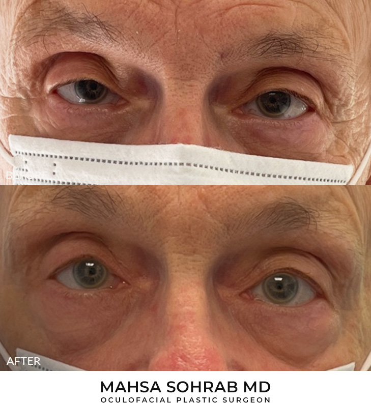 Ptosis Repair Patient 12
